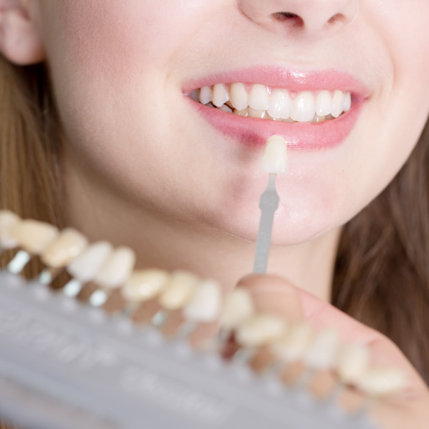 Quanto costano le faccette dentali | Studio Dentistico Dental Fabris